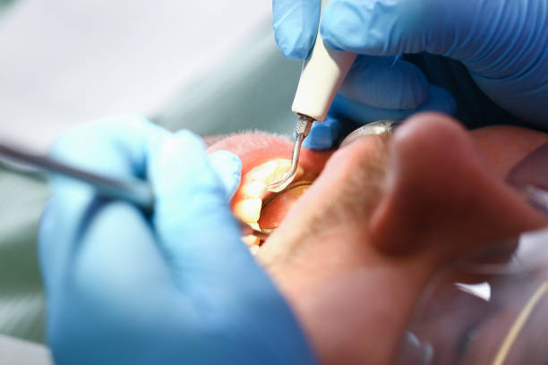 Best Emergency Tooth Extraction in Port Washington, WI