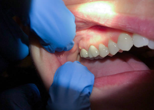 Best Emergency Treatment for Dental Infections or Abscesses in Port Washington, WI